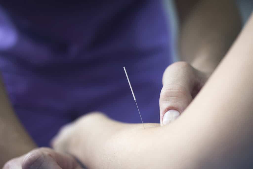 647a4232a4e9a08c7646dd7d calgary dry needling